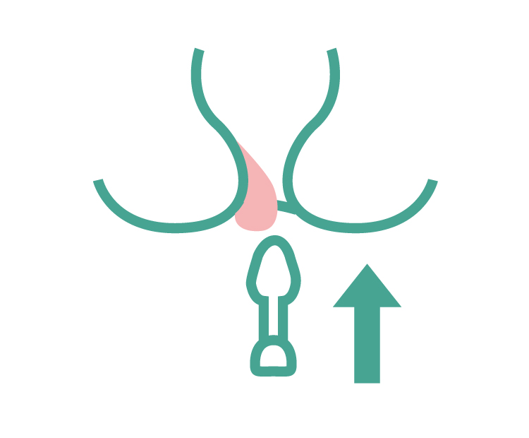 Insert De-nice into the anus without strain