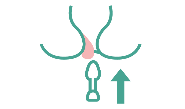 It is possible to easily prevent anal prolapse yourself